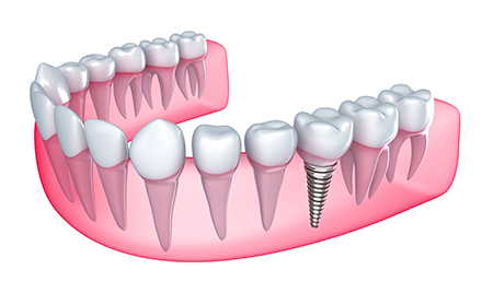 dental implant closeup image